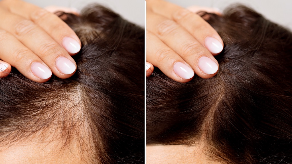 Hair Growth Problems